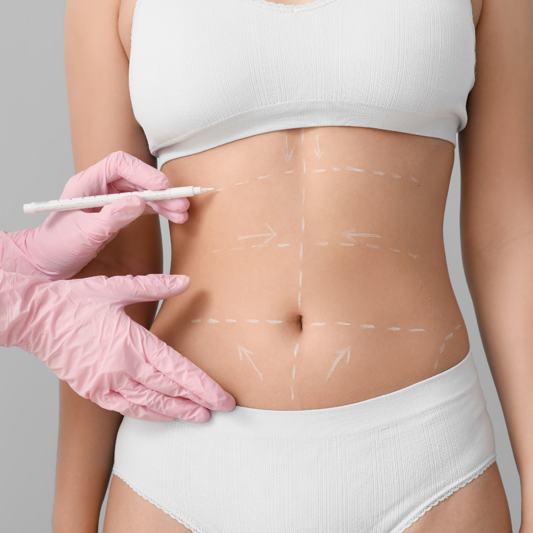 Chirurgo per lipoaspirazione a Credaro